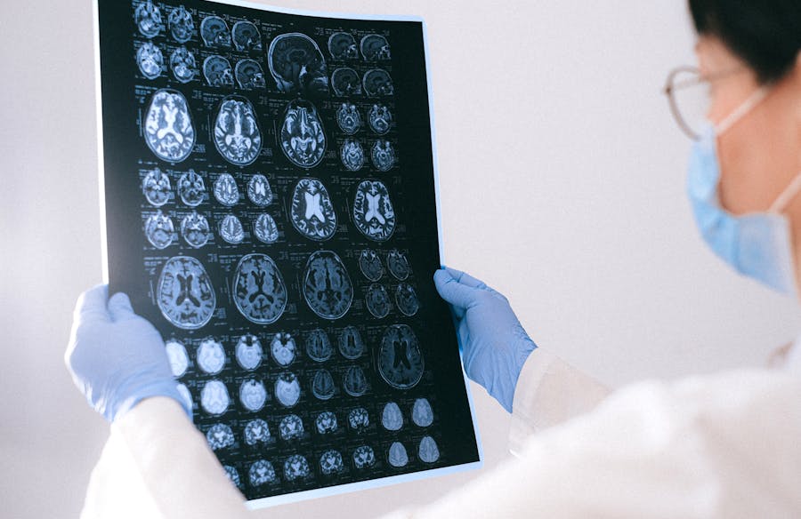 Udar mózgu – objawy, przyczyny, leczenie